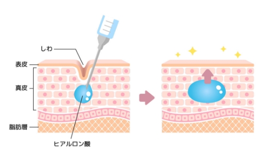 ヒアルロン酸注射とは