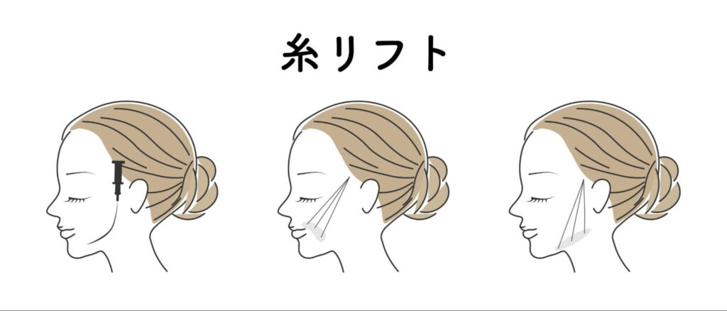 糸リフトをイメージした女性のイラスト