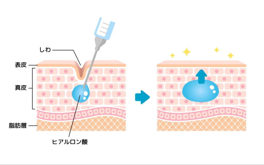 ヒアルロン酸注入の図